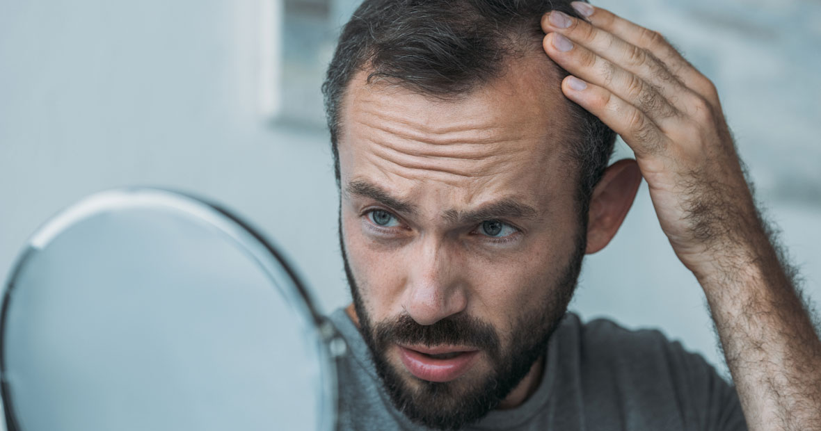 prévenir la calvitie
